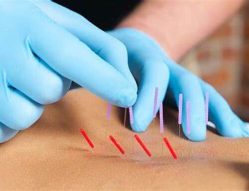 What is Dry Needling and How Can it Relieve Your Pain?